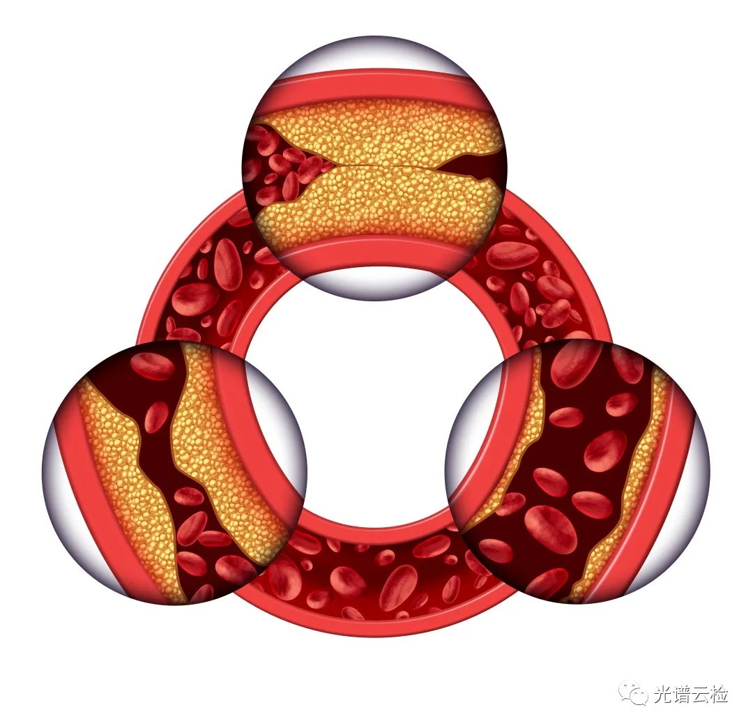 ASCVD危险分层，“三高”治疗不得不知道